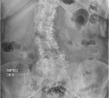Escoliosis degnerativa del adulto, debe ser evaluada por un cirujano de columna